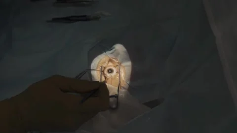 Eye surgery, shooting video from hands Stock-Footage 322625366