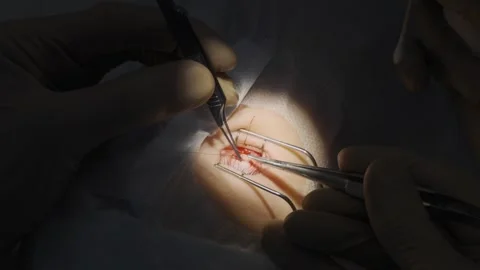 Eye surgery, shooting video from hands Stock-Footage 322626688