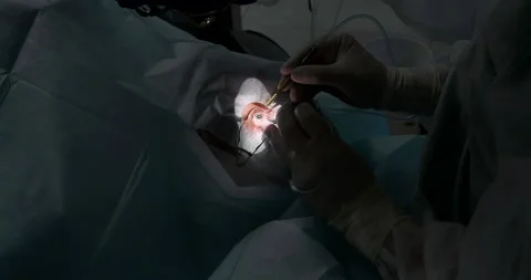 Eye surgery. The surgeon in the operating room performs an operation on the Stock Footage 155648378