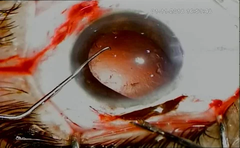 Eye Surgery. Surgeon Performing Operation,  eye vision,correction Stock Footage 128494274