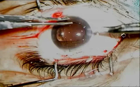 Eye Surgery. Surgeon Performing Operation,  stitching , eye vision Stock Footage 128494533