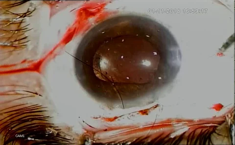 Eye Surgery. Surgeon Performing Operation,  eye vision,correction Stock Footage 128494557