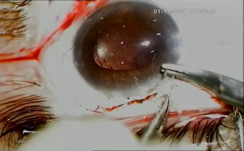 Eye Surgery. Surgeon Performing Operation,  Stitching, Eye Vision,Correction Stock Footage 128555752