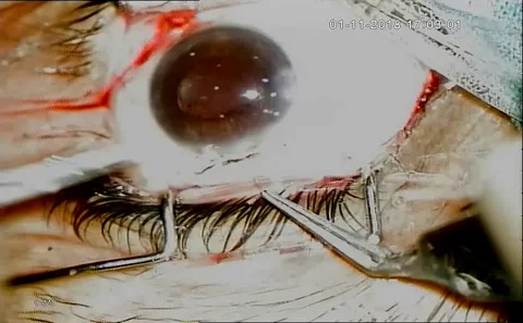 Eye Surgery. Surgeon Performing Operation, Stitching, Eye Vision,Correction Stock Footage 128555918