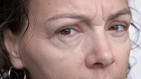 Eye swelling from mascara Stock-Footage 332239124