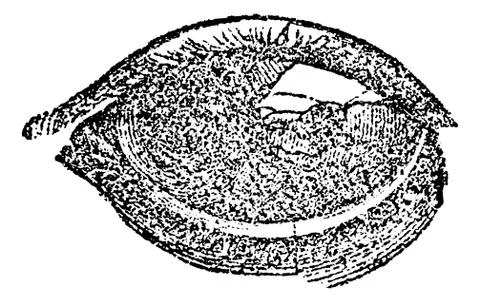 Eye with Vesicular or Pustular Keratitis, vintage engraving Stock Illustration
