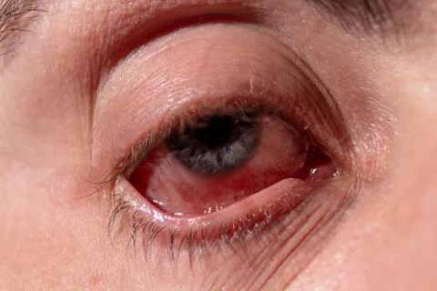An eyelid is pulled out from a sick eye with inflamed veins from infection 스톡 사진