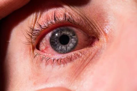 An eyelid is pulled out from a sick eye with inflamed veins from infection 스톡 사진