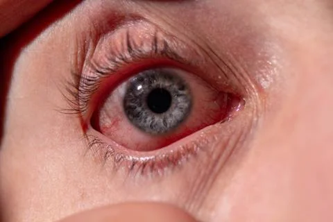 An eyelid is pulled out from a sick eye with inflamed veins from infection Фото