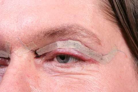 Eyelid surgery Foto stock