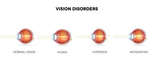 Eyesight disorders Illustrazione stock