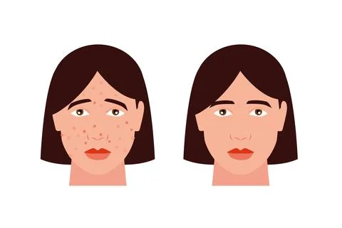 Face with acne and without acne vector Stock-Illustration