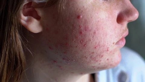 Face with acne problem, close-up Stock Footage 73687725