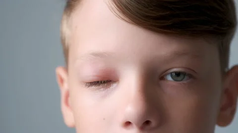 Face of boy with a swollen eye from an insect bite. Allergy to insect bites. Stock Footage 158199955