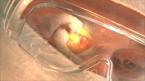 Face a doctor during surgery,  reflection in the glasses Stock-Footage 10579693