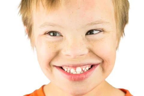 The Face of Downs Syndrome Stock Photos