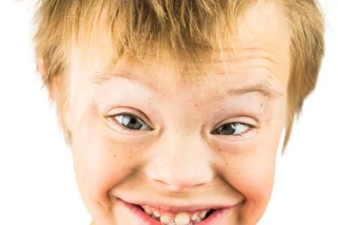 The Face of Downs Syndrome Stock Photos