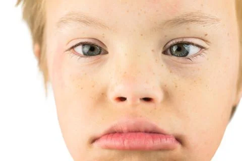 The Face of Downs Syndrome Stock Photos