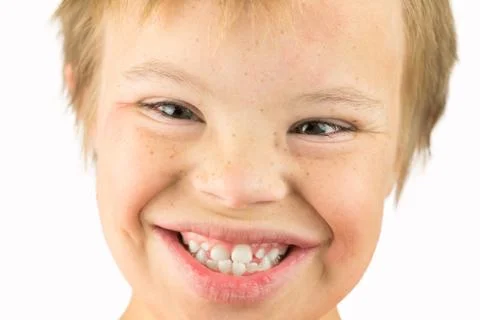 The Face of Downs Syndrome Stock Photos