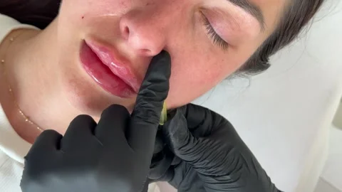 Face lifting PDO Suture operation. innovative technique of New thread lift Stock Footage 321641092