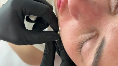 Face lifting PDO Suture operation. innovative technique of New thread lift Stock Footage 321641593