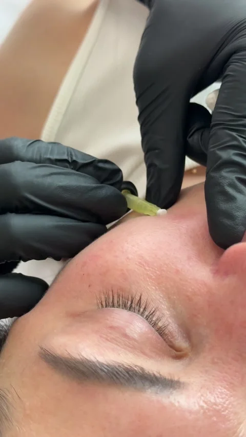 Face lifting PDO Suture operation. innovative technique of New thread lift Stock Footage 321641601