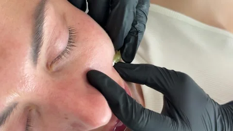 Face lifting PDO Suture operation. innovative technique of New thread lift Stock Footage 321641724