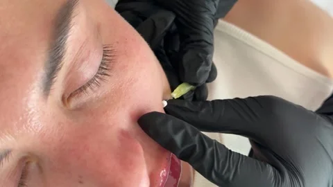 Face lifting PDO Suture operation. innovative technique of New thread lift Stock Footage 321641772