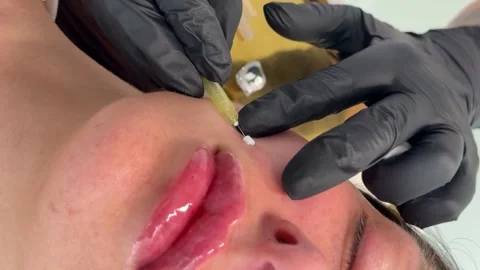 Face lifting PDO Suture operation. innovative technique of New thread lift Stock Footage 321641813