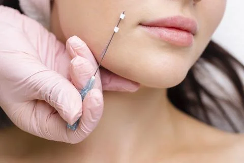 Face lifting PDO Suture operation. innovative technique of New thread lift Stock Photos