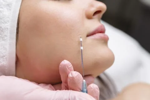 Face lifting PDO Suture operation. innovative technique of New thread lift Stock Photos