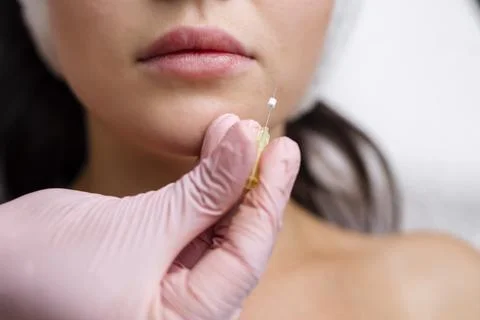 Face lifting PDO Suture operation. innovative technique of New thread lift Stock Photos