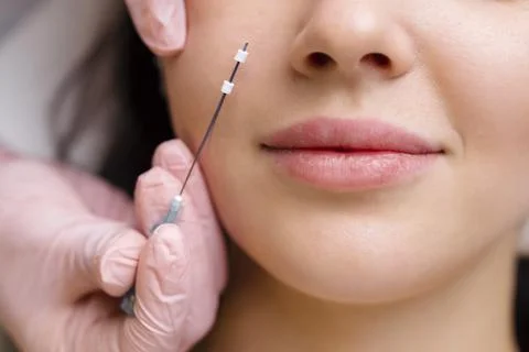 Face lifting PDO Suture operation. innovative technique of New thread lift Stock Photos