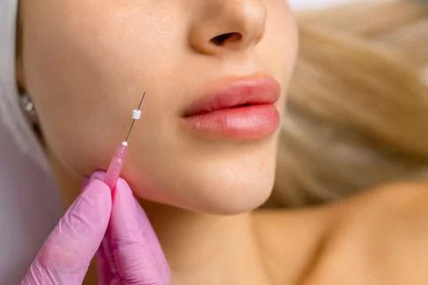 Face lifting PDO Suture operation. innovative technique of New thread lift Stock Photos