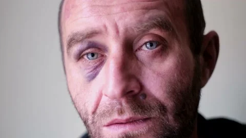 The face of a man with a bruise under the eye. Video stock 166182317