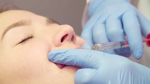 Face of patient during lip augmentation Video stock 84674054