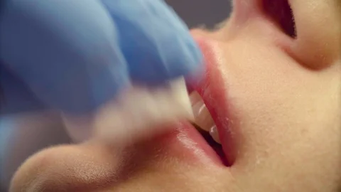 Face of patient during lip augmentation Video stock 88731487