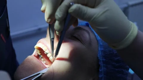 Face of patient, hands of dentist sutured wound after tooth extraction and Stock Footage 276364236