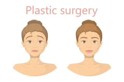 Face plastic surgery. Stock Illustration