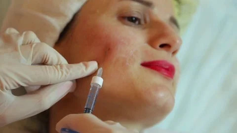 Facelift with injectables Video stock 83506312