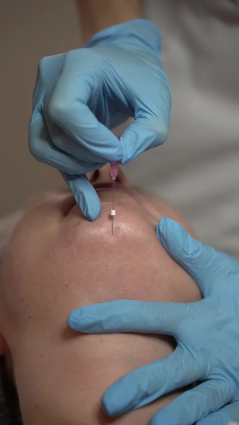 Facelift with PDO meso threads. Anti-aging procedure. Vertical video 4K. Video stock 289189000