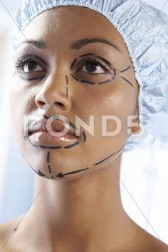 Facelift Surgery Markings