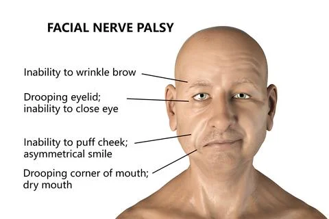 Facial nerve paralysis Stock Illustration
