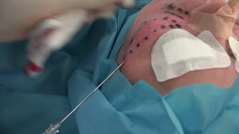 Facial or Plastic  Surgery 1 動画素材 95495194