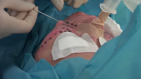 Facial or Plastic  Surgery 2 動画素材 95495144