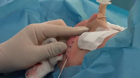 Facial or Plastic  Surgery 3 動画素材 95494821