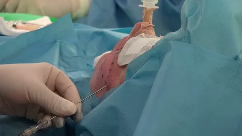 Facial or Plastic  Surgery 4 動画素材 95495532