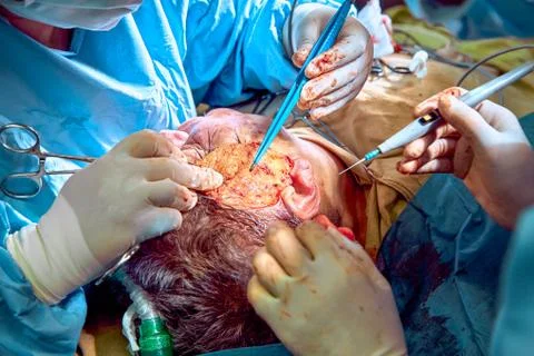 Facial plastic surgery operation. Face lift surgery. Surgeon separated the skin Foto stock