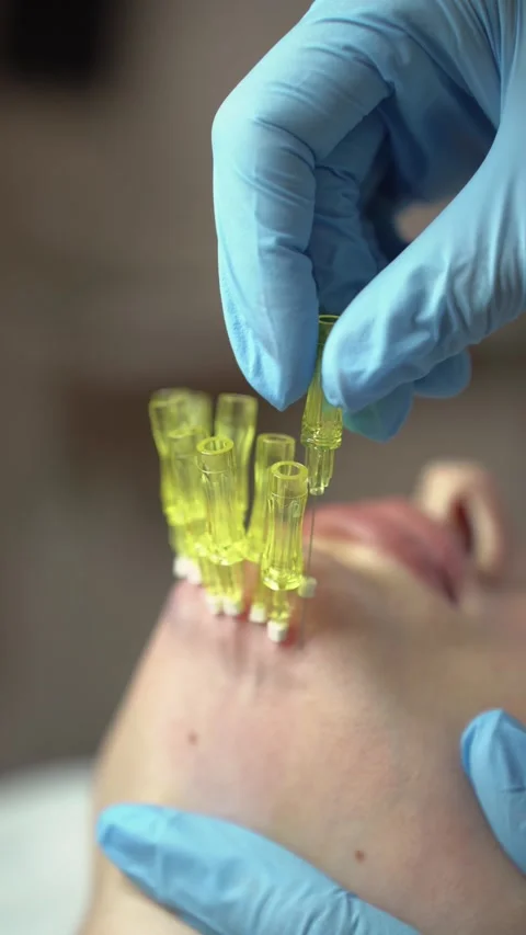 Facial rejuvenation procedure using PDO meso threads. Close up vertical video 4K Video stock 289188983