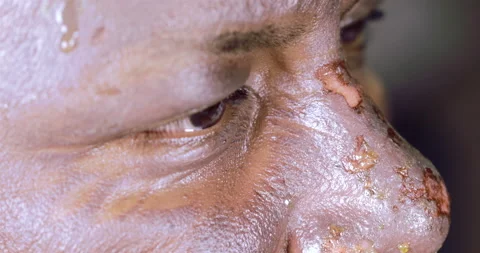 Facial Second Degree Burns Blisters Video stock 148512972